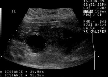 An initial prenatal sonogram. This image demonstra