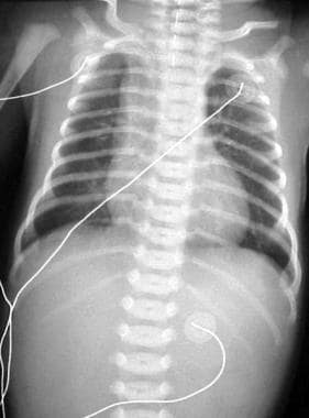 Isolated esophageal atresia (EA). Frontal view of 