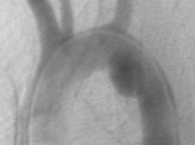 Aorta, trauma. Left anterior oblique (45°) angiogr