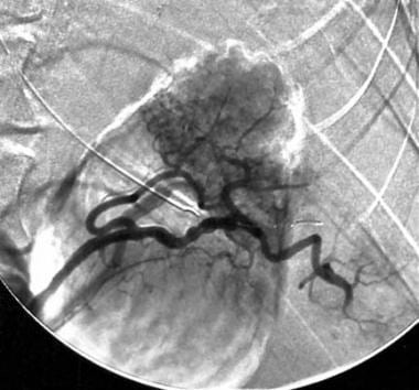 Splenic artery postembolization arteriogram in a 3