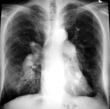 Pulmonary angiography. Chest radiograph shows mark