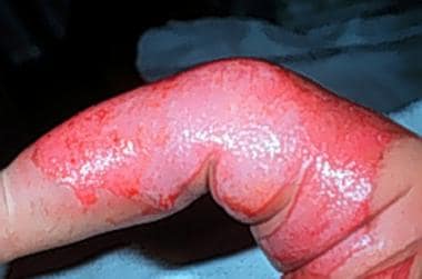 Second-degree burns are often red, wet, and very p