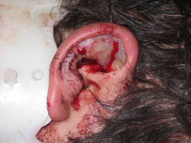 Auricular hematoma. 