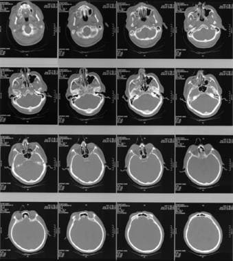Orbitofacial CT scans showing maxillary sinus and 