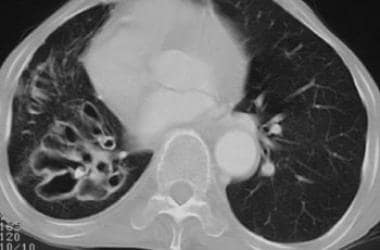 CT scan of a patient with bronchiectasis. Note tha
