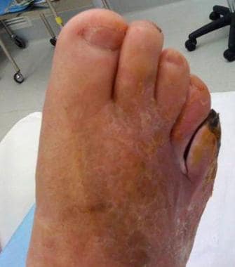 Gangrenous fifth toe. Dubious perfusion in fourth 