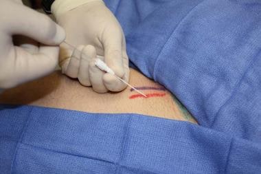 Femoral artery cannulation (Seldinger). Insertion 