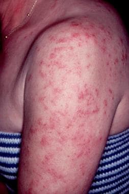 Early lesions of subacute cutaneous lupus erythema