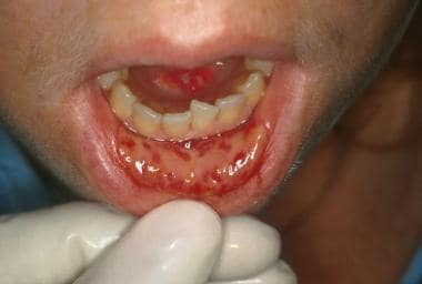 Ulcerative oral mucositis lesions on the labial mu