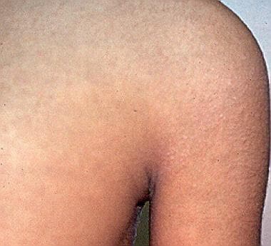 Multiple skin-colored shiny papules associated wit
