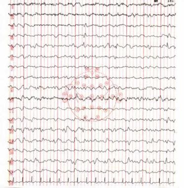 EEG in a 56-year-old man with uremic encephalopath