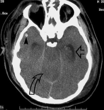 Head CT demonstrates enlargement of the temporal h