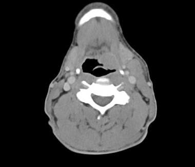 An axial CT scan of the neck with contrast again d