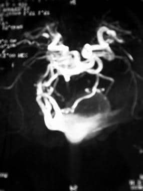 MRI venogram showing vein of Galen malformation wi