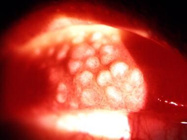 giant papillary conjunctivitis treatment