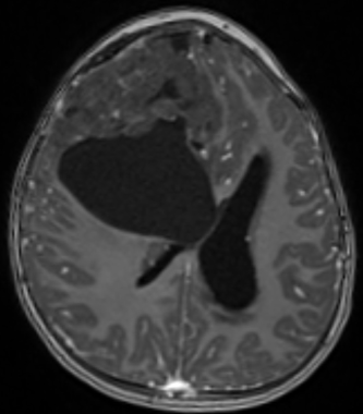 T1 with contrast of large right frontal tumor, sho