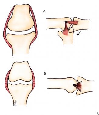 Proximal interphalangeal (PIP) joint collateral li