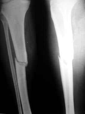 Patient with tibia nonunion. a X-ray from the pre-treatment period