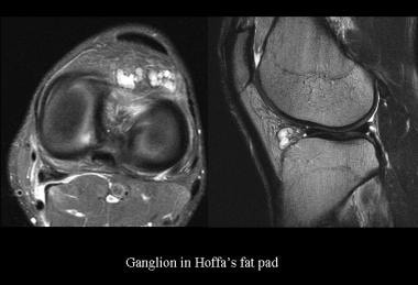 Ganglion in the Hoffa fat pad. Courtesy of James K