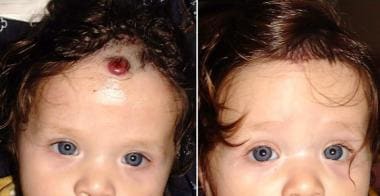 Resection of a bleeding forehead hemangioma. 