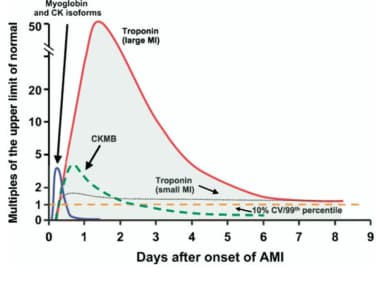 Timing of release of various cardiac biomarker pea