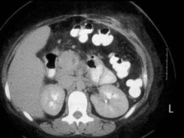 CT scan demonstrating thrombosis of superior mesen