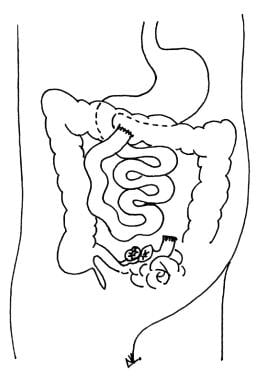 Bypass of fistulous bowel loops that are densely a