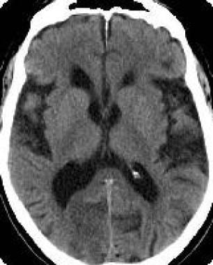 Computed tomography (CT) scan of the brain showing