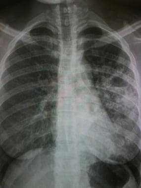 Pulmonary tuberculosis with air-fluid level. 