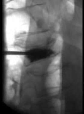 Fluoroscopic view of a kyphoplasty procedure. 