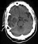 Glioblastoma Multiforme