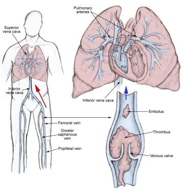 pulmonary embolism diagram