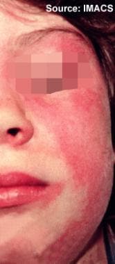 What Is The Appearance Of Malar Rash In Systemic Lupus