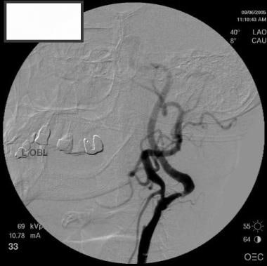 Oblique view of left carotid artery demonstrating 