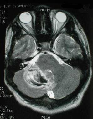 MRI demonstrating right cerebellar hemorrhage.