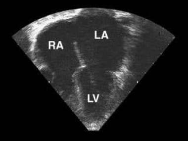 Echocardiographic 4-chamber view of a child with r