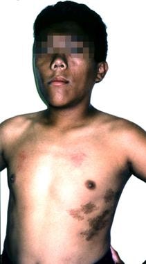 Gigantism and Acromegaly. A 12-year-old boy with M