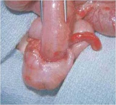 Pediatric Small Bowel Obstruction. The surgical im
