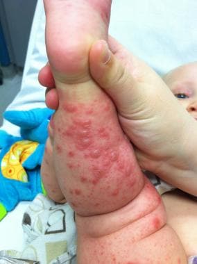 Calf blisters from coxsackievirus A6 as seen in at