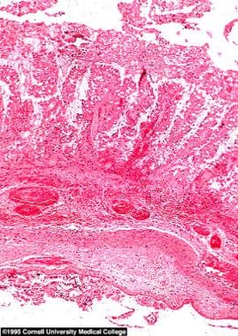 黏膜切片显微图显示粘膜透壁