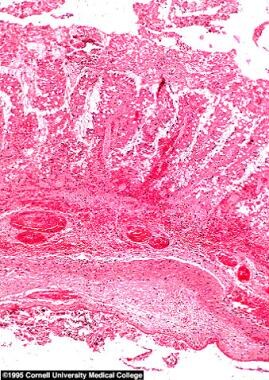 necrotizing enterocolitis histology