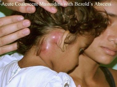 mastoiditis in adults