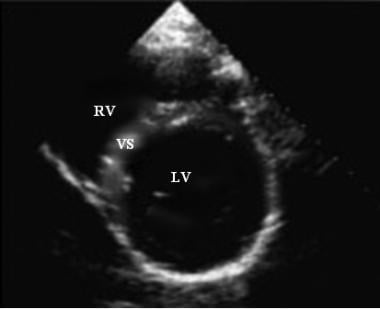 Ultrasound image of parasternal short-axis view. 