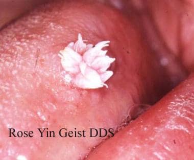 Wart on the tongue, Hpv white tongue, Wart tongue white - vacante-insorite.ro