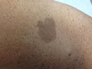 A light-brown hyperpigmented lesion is noted on th