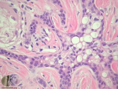 Eccrine carcinoma pathology. Tubule and gland form