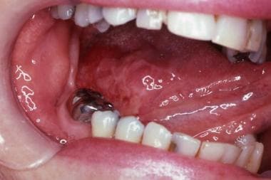 Oral squamous cell carcinoma on the midlateral bor