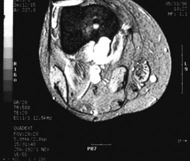 Axial MRI of a periosteal chondroma demonstrating 