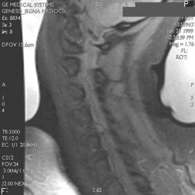 T1-weighted MRI of cervical disk herniation. 