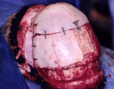 Correction of sagittal craniosynostosis. Skull is 